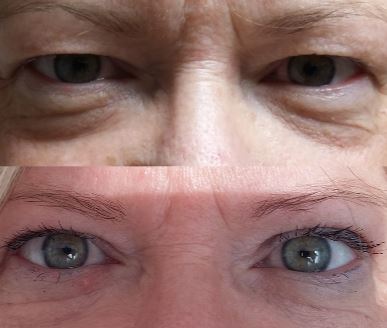 Operacija blefaroplastika