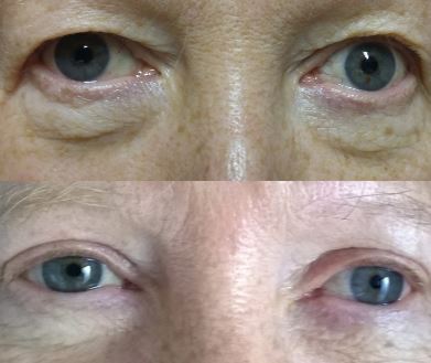 blefaroplastika (1)